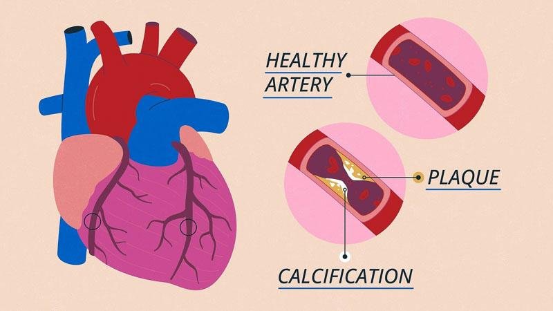 GMCA Coronary Artery Calcification Animation Storyboard04